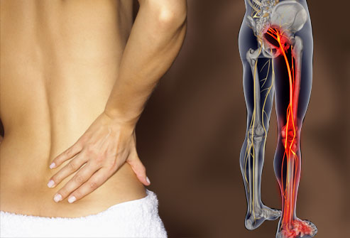 Lower Back Pain That Radiates Down Both Legs Quick Tips
